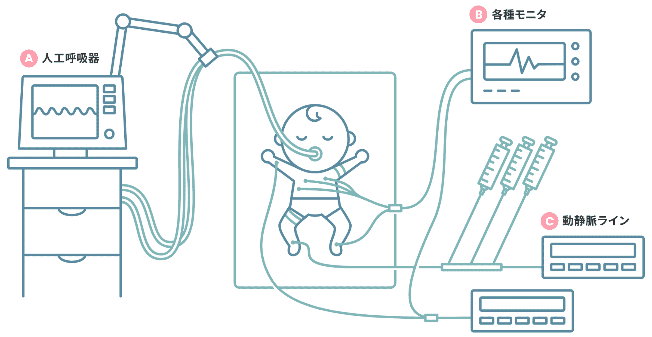 新生児発作とは何ですか?